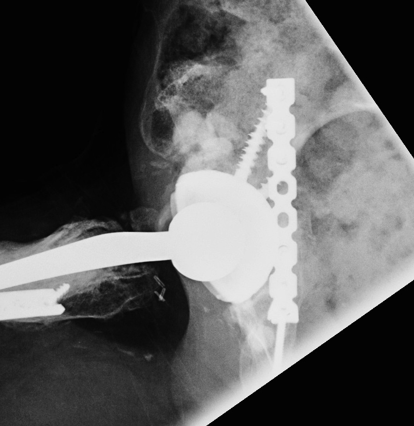 Revision THR Plate Posterior Column Lateral